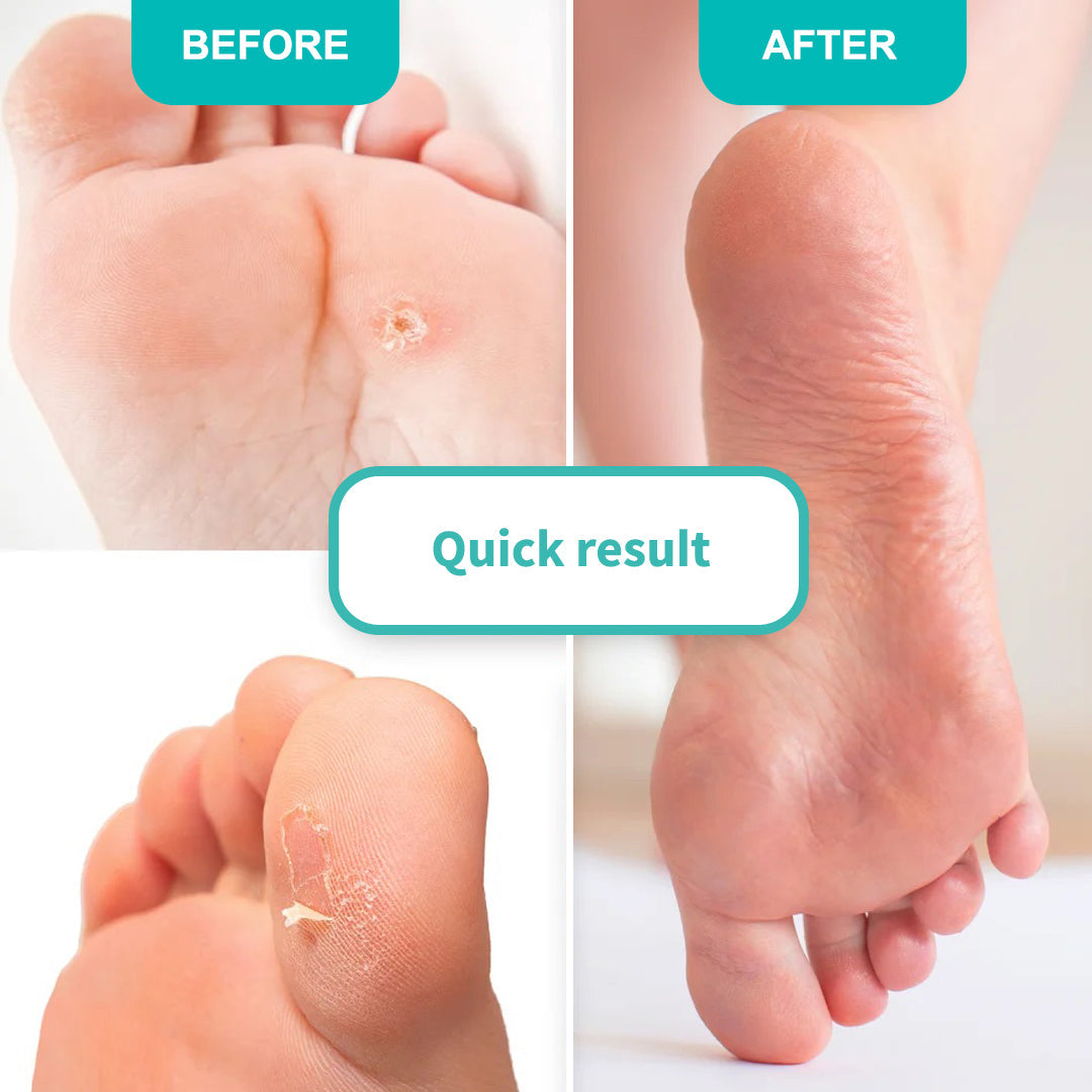 FOOT CALLUS SOFTENING GEL For topical application 100 ml