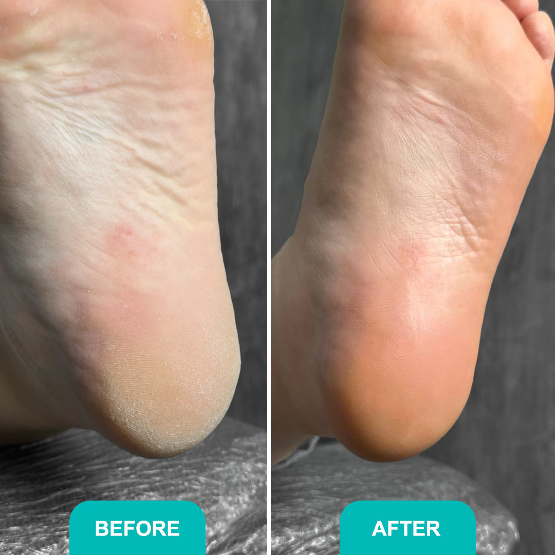 FOAM EXPRESS SOFTENER Fast, effective relief for rough, callused feet 150 ml